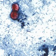 EUA confirma las primeras muertes relacionadas con brote de Cyclospora 10 02 2