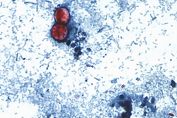EUA confirma las primeras muertes relacionadas con brote de Cyclospora 3 02 2